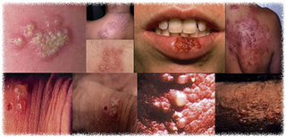 Illustration for article titled Obat penyakit herpes pada anak kecil